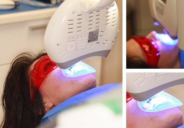 blanqueamiento-dental-laser